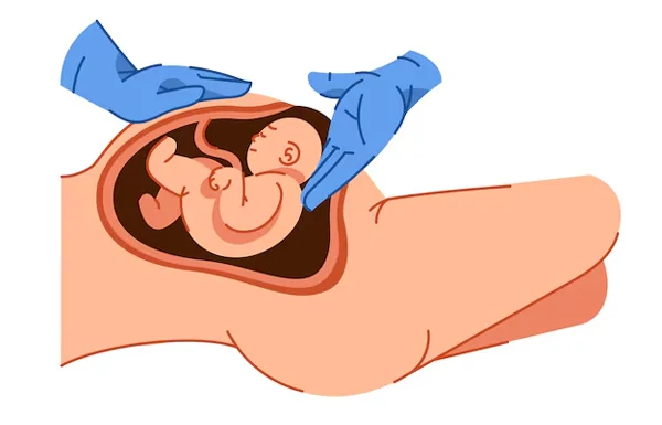 Vaginal Birth After Cesarean Section
