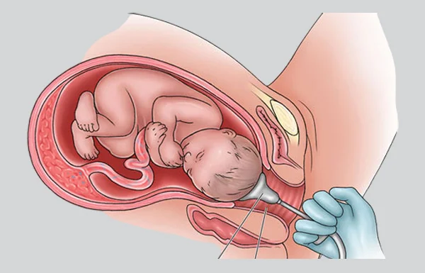 Vacuum Assisted Vaginal Delivery