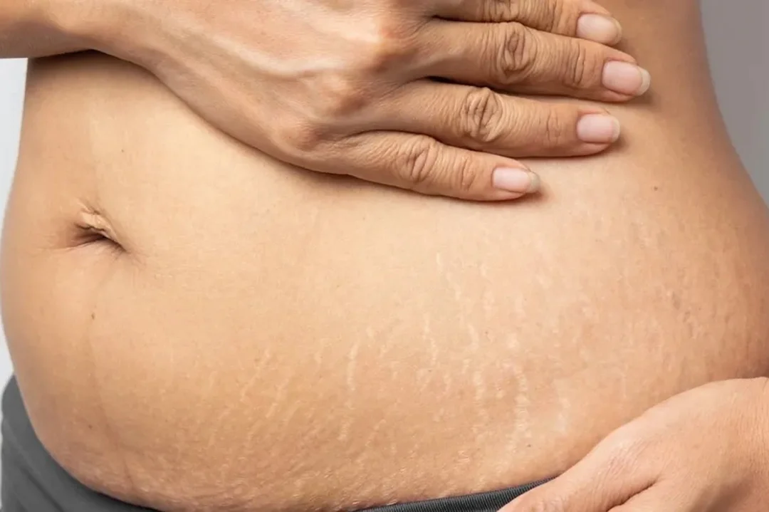 Minimal Scar Family Planning Procedure