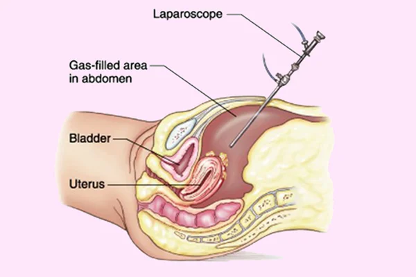Abdominal Hysterectomy