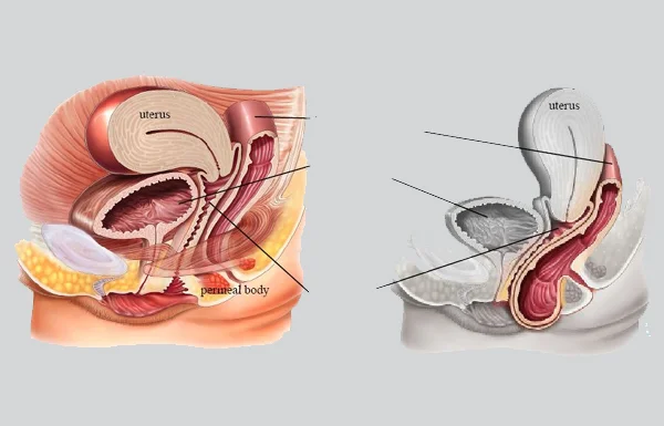 Perineal Floor Repair